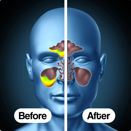 Drenador de senos nasales + REGALO GRATIS